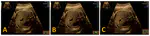Expected‐value bias in routine third‐trimester growth scans